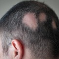 Alopecia: Understanding Hair Loss and Finding Solutions