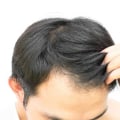 Stress Management for Hair Health: Tips and Techniques for Preventing Baldness and Promoting Hair Regrowth