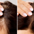 A Comprehensive Look at Medical Treatments for Female Hair Loss