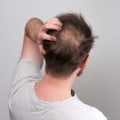 Understanding Finasteride: A Comprehensive Look at Hair Loss Prevention and Treatment