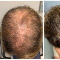 Understanding Scalp Treatments for Hair Growth