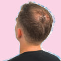 Diagnosing Male Pattern Baldness: Understanding Causes, Treatments, and Prevention