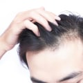 Vitamin D for Hair Growth: The Ultimate Guide to Preventing Baldness and Restoring Your Hair