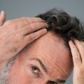 Genetics and Male Pattern Baldness: Understanding the Causes and Finding Solutions