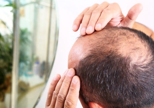 Lifestyle Factors and Male Pattern Baldness: Understanding the Causes and Preventing Hair Loss