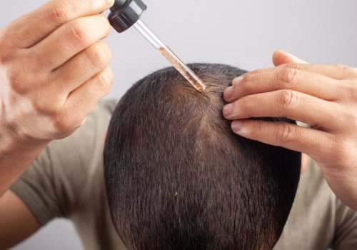 Understanding Minoxidil: A Guide to Preventing Hair Loss and Promoting Hair Growth