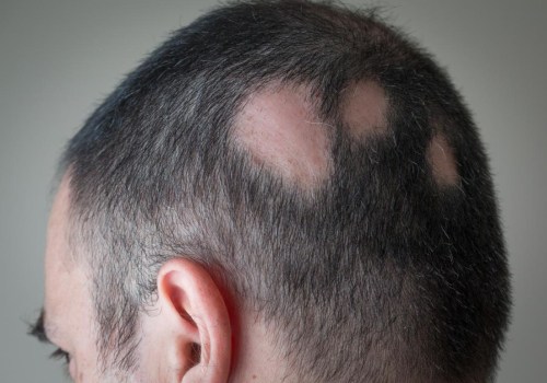 Alopecia: Understanding Hair Loss and Finding Solutions