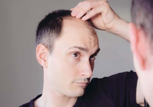 Lifestyle Changes for Preventing Male Pattern Baldness