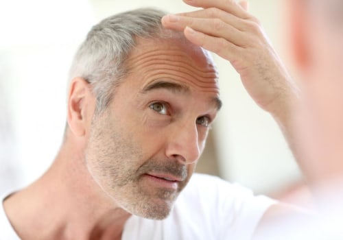 All You Need to Know About Male Pattern Baldness