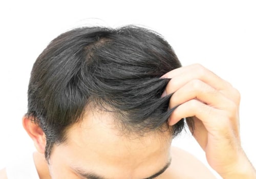 Stress Management for Hair Health: Tips and Techniques for Preventing Baldness and Promoting Hair Regrowth