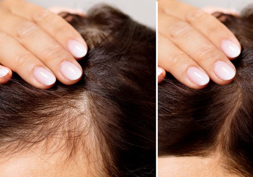 A Comprehensive Look at Medical Treatments for Female Hair Loss