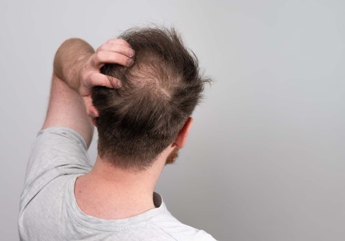 Understanding Finasteride: A Comprehensive Look at Hair Loss Prevention and Treatment