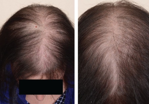 Understanding Female Pattern Hair Loss