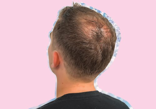 Diagnosing Male Pattern Baldness: Understanding Causes, Treatments, and Prevention