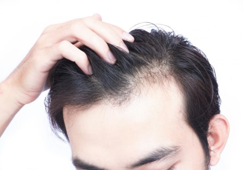 Vitamin D for Hair Growth: The Ultimate Guide to Preventing Baldness and Restoring Your Hair