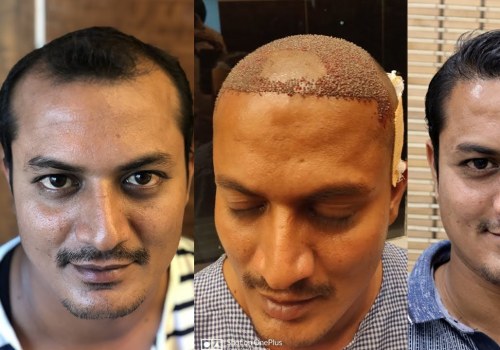 Hair Transplants: Everything You Need to Know