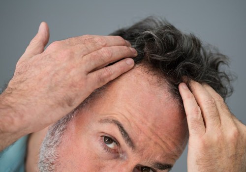 Genetics and Male Pattern Baldness: Understanding the Causes and Finding Solutions